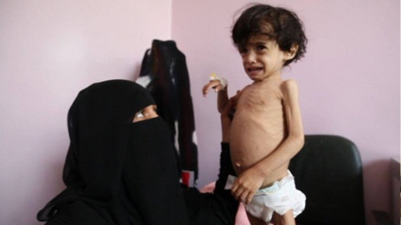 Na hiljade jemenske djece boluje od pothranjenosti
