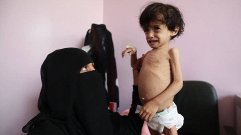 Na hiljade jemenske djece boluje od pothranjenosti
