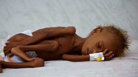 Upozorenje UN-a na pothranjenost jemenske djece nakon saudijskih napada