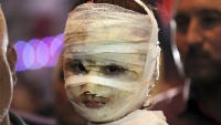  Iračko dijete povrijeđeno u eksploziji u toj zemlji