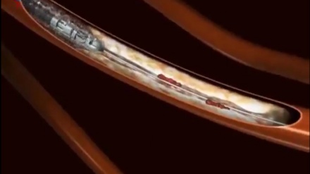 بیبینن - ماڵئاوایی لەگەڵ جەڵتەی دڵ بە ڕۆبۆتێک کە دەمارەکان دەکاتەوە