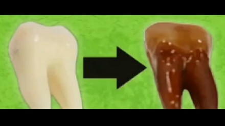 کاریگەری ساردەمەنی گازدار لەسەر ددان پاش تێپەڕینی پێنج ڕۆژ