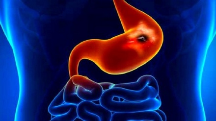 نەخۆشییەکانی ئەسنا ئەشەر و مێعده