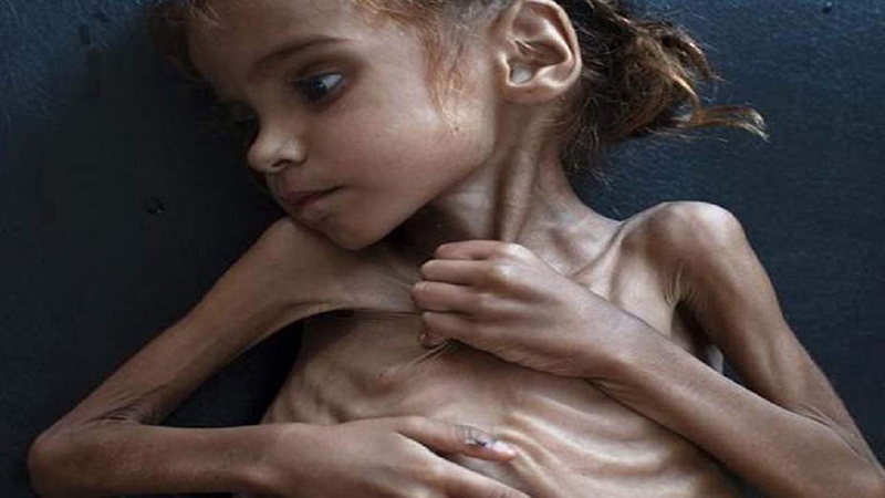 یمن میں سعودی جارحیت اور قحط کی علامت بننے والی بچی دم توڑ گئی