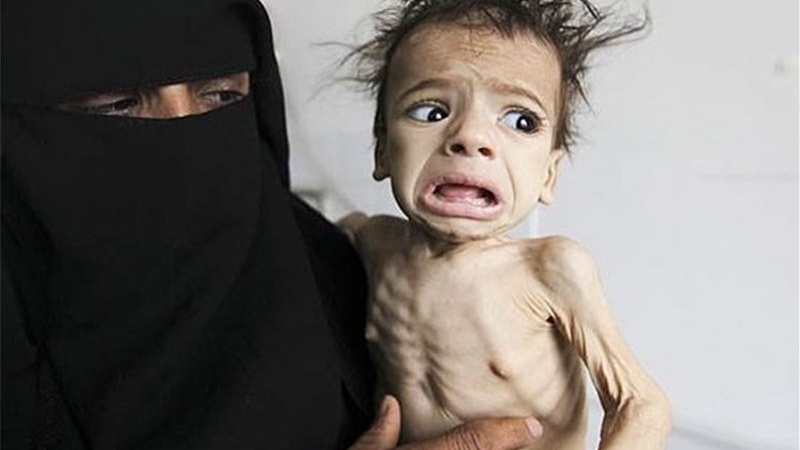 خوراک کا عالمی دن اور یمن میں بھوک مری