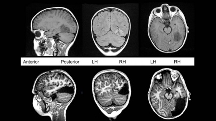 Koronavirusun insan beynindəki fəsadları aşkarlanıb