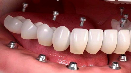 İranın istehsal etdiyi diş implantının təqdimatı olub