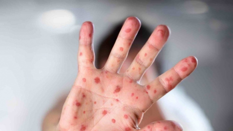  Përhapja e lisë së majmunëve në Evropë