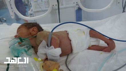 Rekordan broj malformacija novorođenčadi u Jemenu