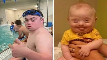 ډاون سنډروم (Down Syndrome) په اړه معلومات