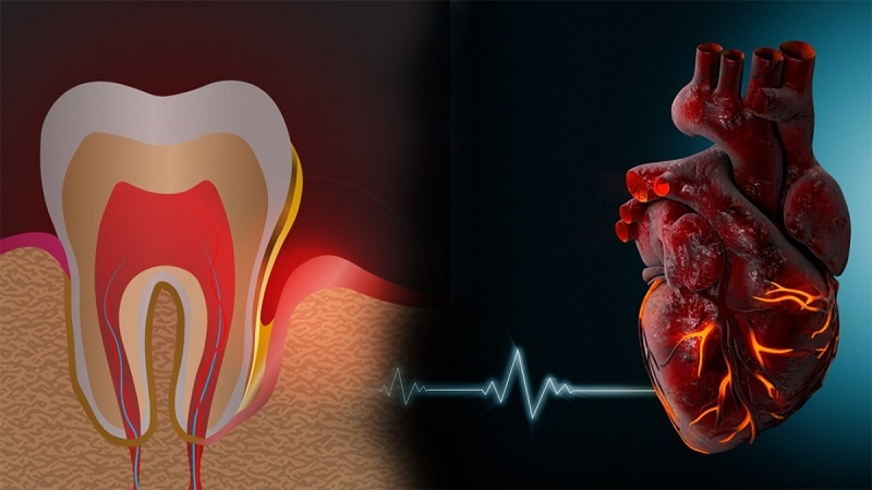 چ پەیوەندییەك لەنێوان دەم و ددان و نەخۆشییەكانی دڵدا هەیە؟