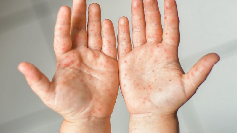 Gəncədə də Qızılca can aldı