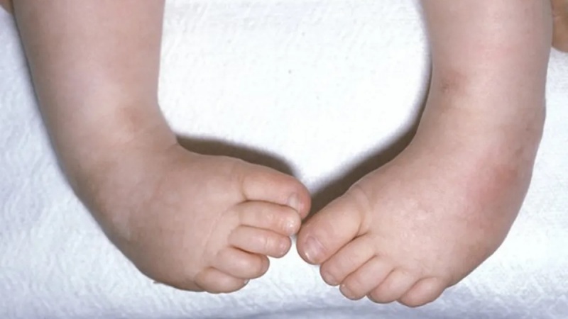 تێکچوونە زگماکییەکانی کۆرپەلە؛ ئەو هۆکارانەی کە دەبنە هۆی ئەم تێکچوونە