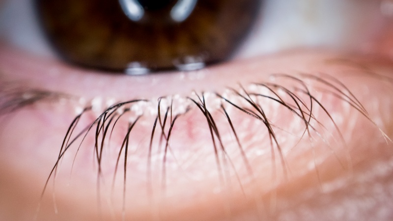 پارێزگاریکردن لە مانەوەی برژانگێکی تەندرووست - بەشی2