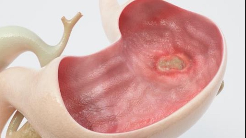 قورحەی گەدە و چارەسەری