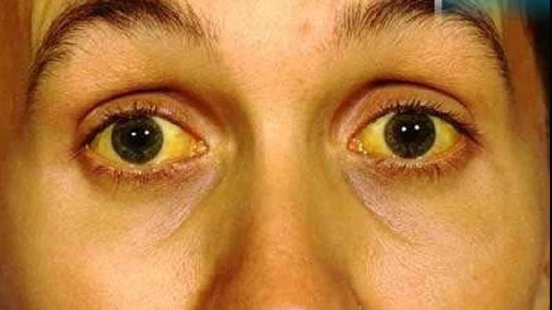 زەردوویی چییە؟ (بەشی یەکەم)