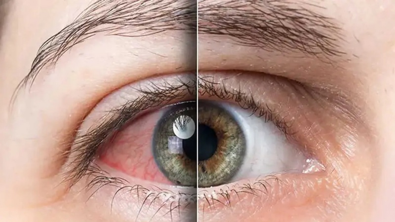 Pêşîgirtin li zuhabûna çavan di hewayê zivistanê da