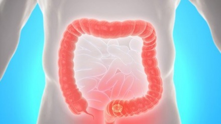  قەبزی چییە و هۆکارەکانی قەبزی کامانەن؟